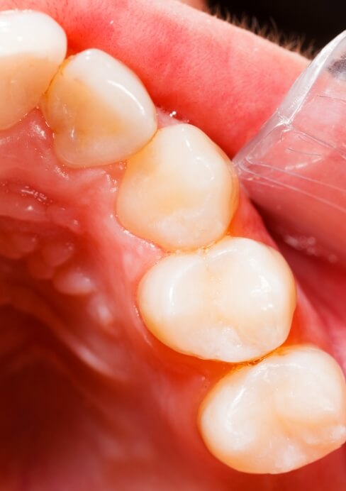 Closeup of smile during the placement of dental sealants