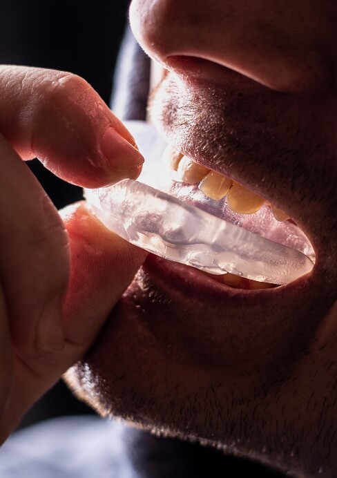 Closuep of person placing a custom athletic mouthguard