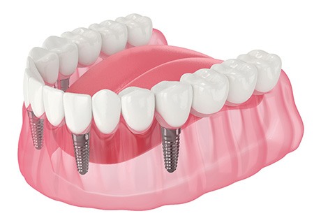 Illustration of an implant denture