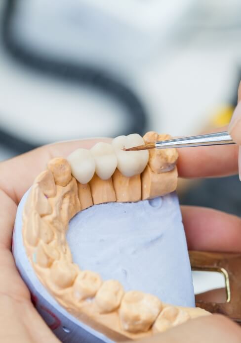 Model smile with fixed bridge restoration