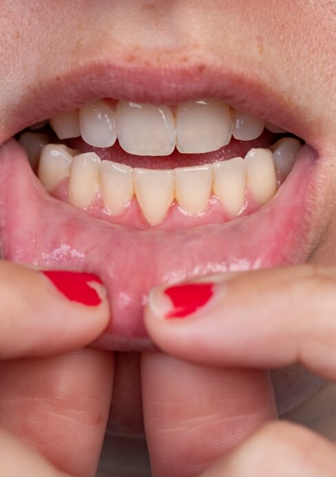 Closeup of healthy smile after pulp therapy