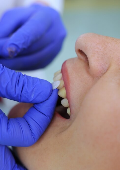 Woman's smile compared with dental bonding shade option