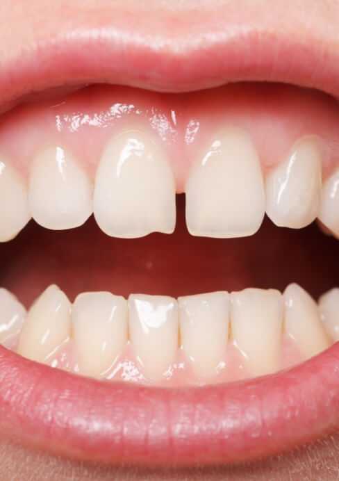 Closeup of smile after gum recontouring