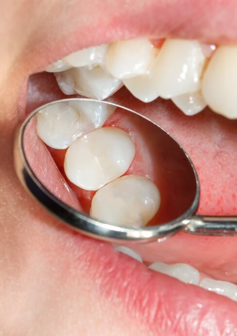 Closeup of smile after dental crown placement