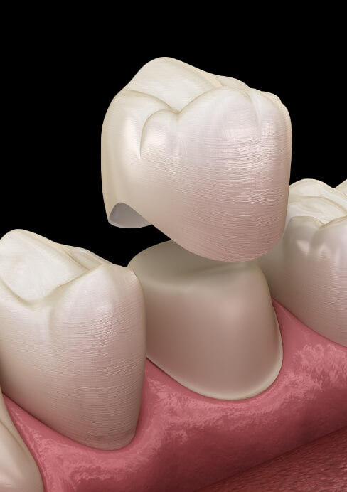 Animated smile during dental crown placement