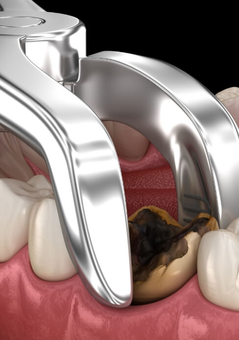 Animated smile during tooth extraction