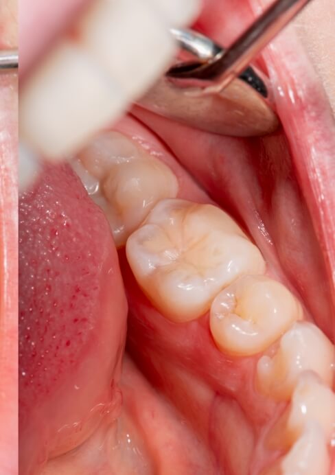 Closeup of repaired smile after tooth colored filling