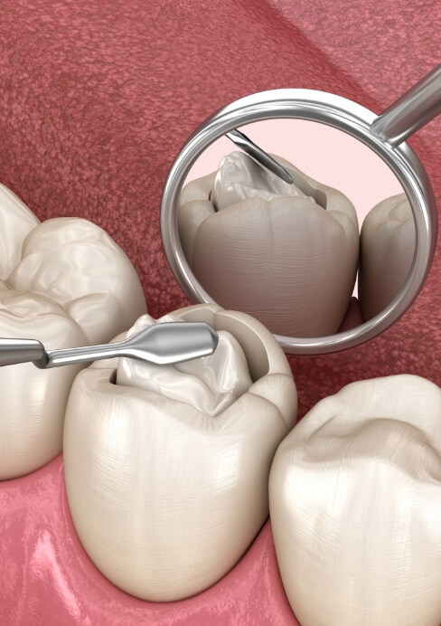 Animated smile during tooth colored filling placement