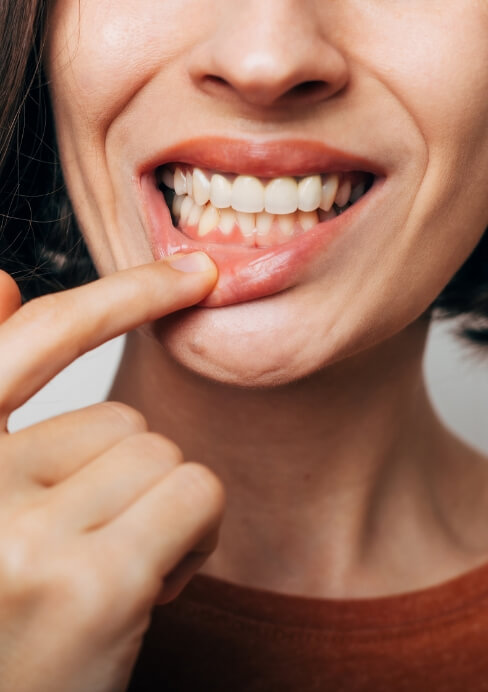 Closeup of smile in need of gum recontouring