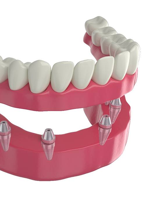 A CGI of how implant dentures attach to the jaw