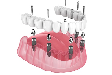 Permanent implant dentures