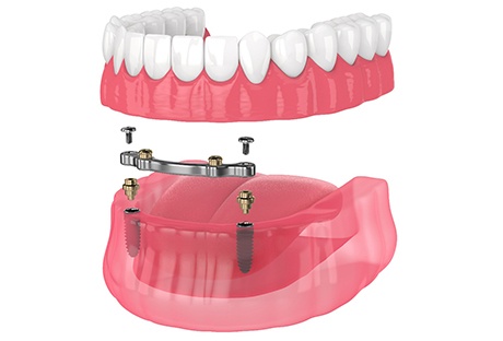 Removable implant dentures