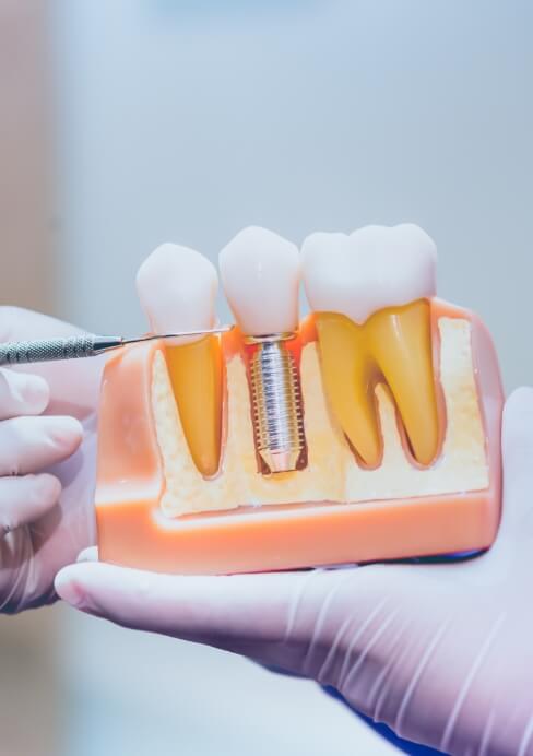 Model smile used to compare dental implants to natural teeth