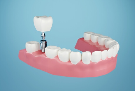 Animated smile during dental implant supported dental crown