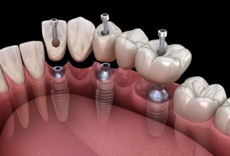 Animated smile during dental implant supported fixed bridge placement