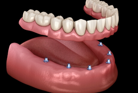 Animated smile during dental implant supported denture placement