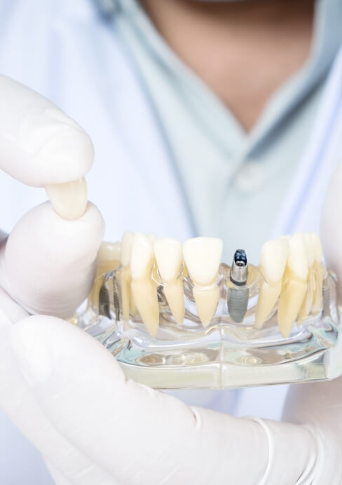 Dentist using model smile to explain the cost of dental implants