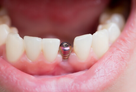 Closeup of smile after dental implant surgery