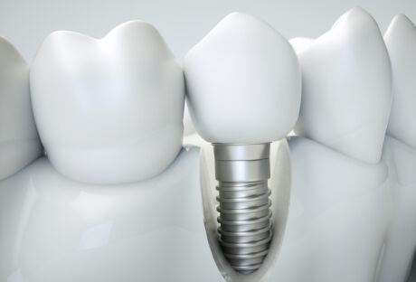 Animated smile used to represent dental implant osseointegration