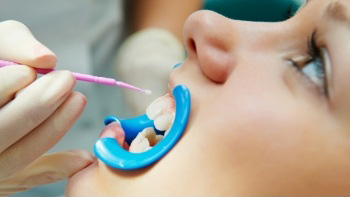 Closeup of dental patient receiving fluoride treatment