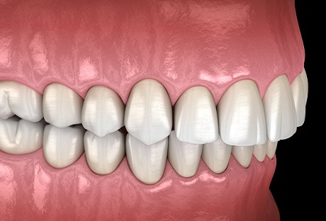 Illustration of an overbite