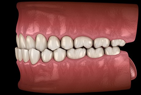 Illustration of an underbite