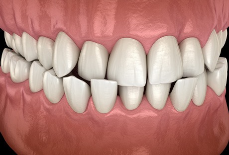 Illustration of a crossbite