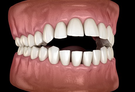 Illustration of an open bite