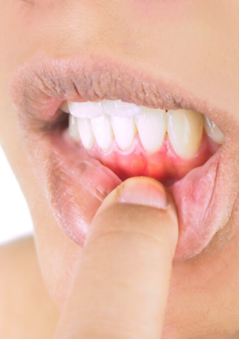 Closeup of damaged smile before gum disease treatment