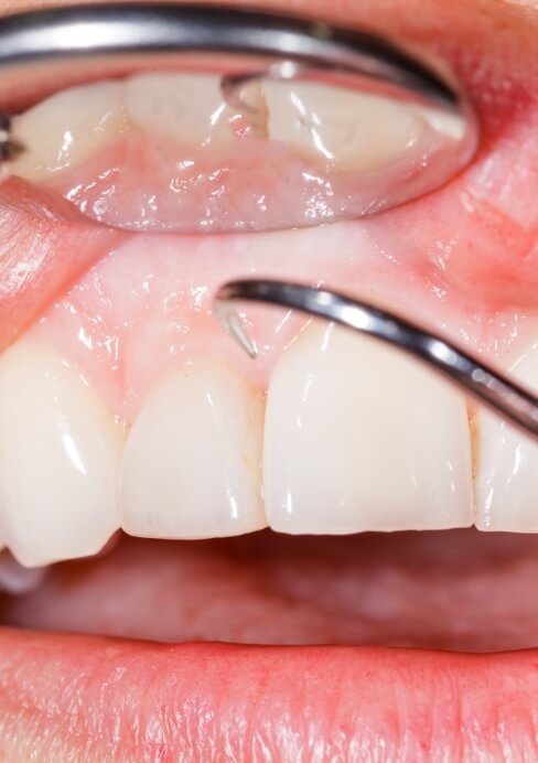 Closeup of smile during gum disease treatment