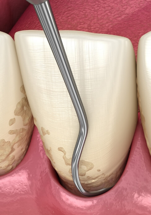 Animated smile during scaling and root planing treatment