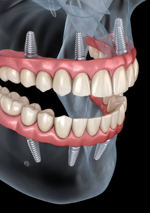Animated smile after full mouth reconstruction
