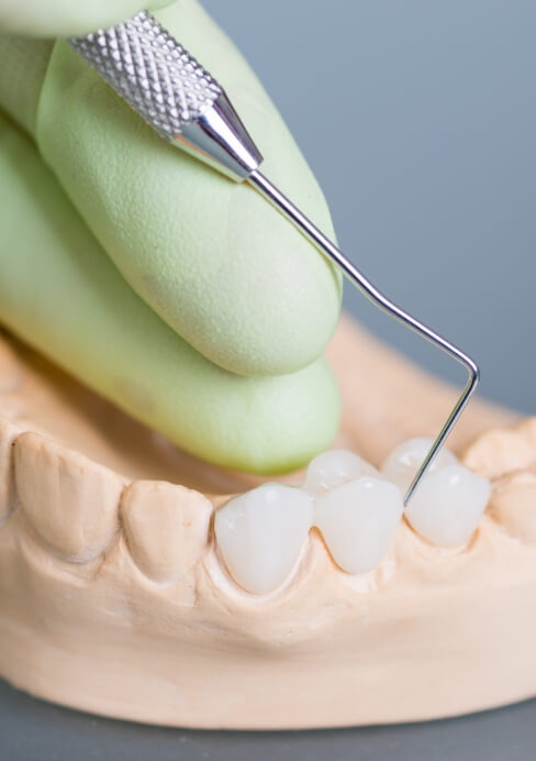 Model smile with dental crown supported fixed bridge