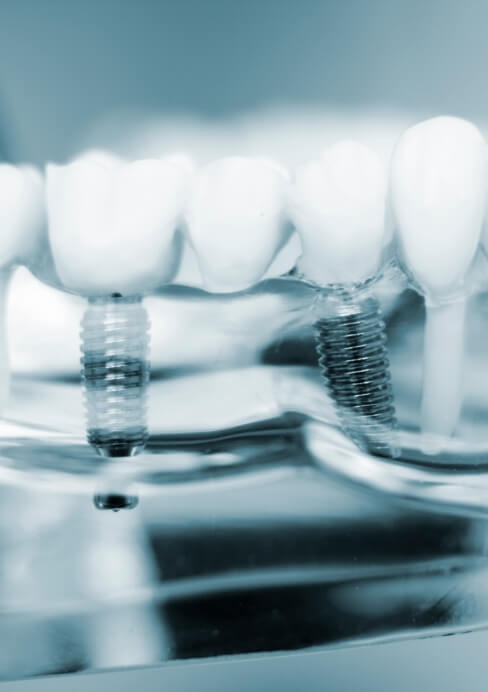 Model smile used to explain root canal treatment