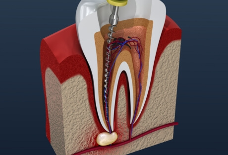 Animated smile during root canal treatment