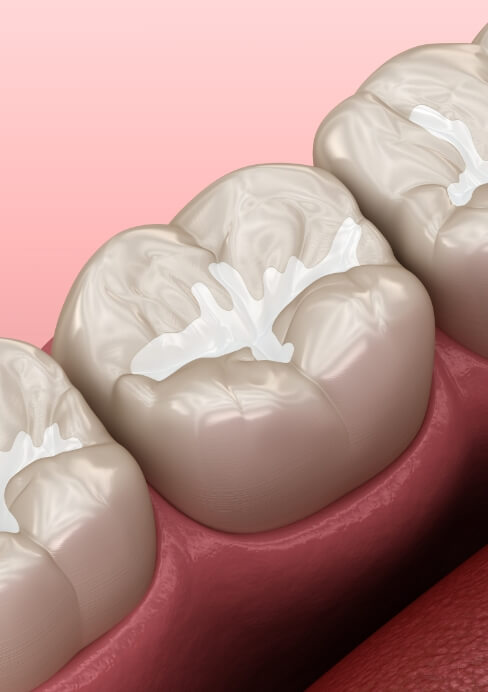 Animated smiles with dental sealants