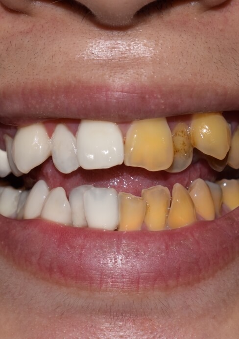 Smile before and after teeth whitening