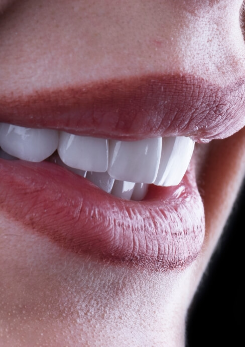 Closeup of flawless smile after veneers treatment