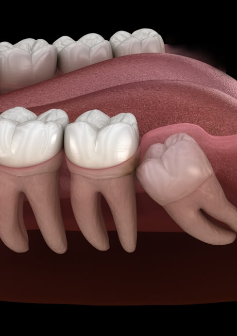 Animated smile with impacted wisdom tooth prior to extraction